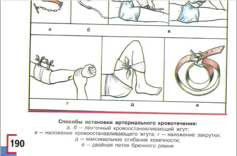 Остановка артериального кровотечения картинки